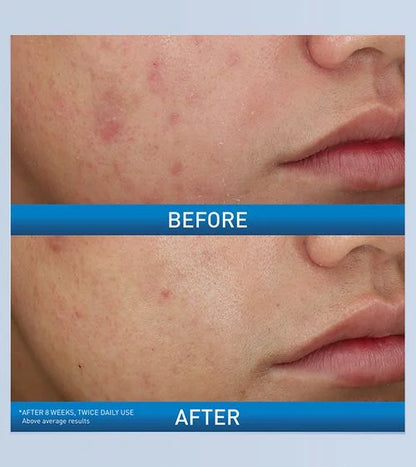 CeraVe Acne Foaming Cream Wash with 10% Benzoyl Peroxide 150g